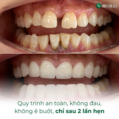 Giá Làm Răng Sứ Tại Thái Bình – Những Điều Cần Biết Trước Khi Làm Răng