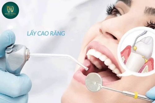 Lấy Cao Răng Định Kỳ Có Cần Thiết Không? Bao Lâu Nên Thực Hiện?