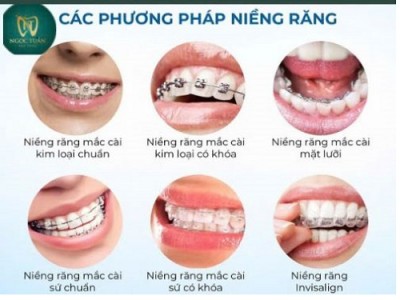 Các Phương Pháp Niềng Răng An Toàn Hiệu Quả