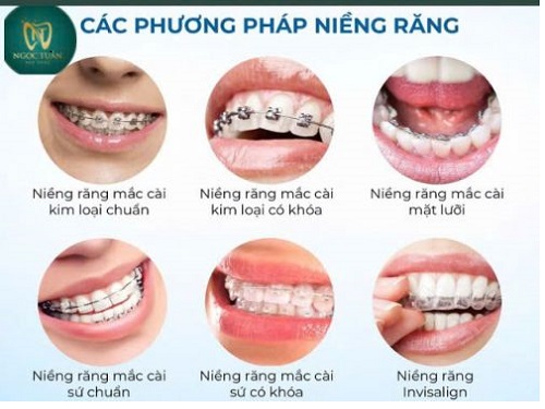 Các Phương Pháp Niềng Răng? Chi Phí Niềng Răng Tại Thái Bình?