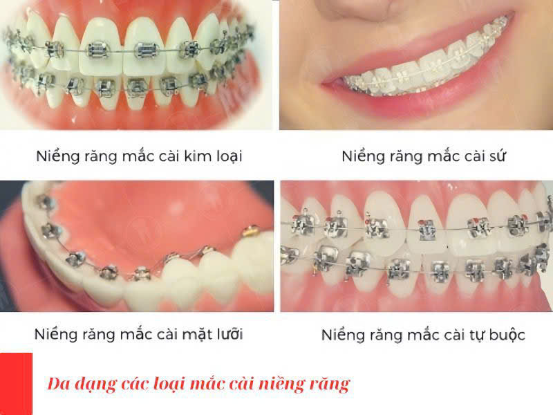 các loại mắc cài niềng răng