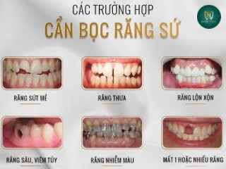 các trường hợp nên bọc răng sứ