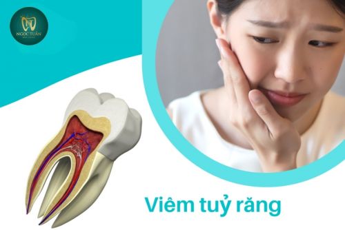 Viêm Tủy Răng Có Nguy Hiểm Không? Khi Nào Cần Điều Trị Tủy?