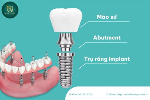 Chi Phí Trồng Răng Implant Ở Hưng Hà – Cập Nhật Mới Nhất