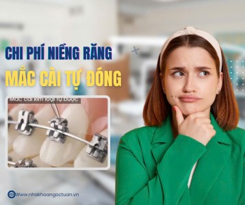 Giá Niềng Răng Mắc Cài Tự Buộc Là Bao Nhiêu? Giá Niềng Răng 2025