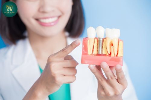 Cấy Ghép Implant Toàn Hàm Ở Quỳnh Phụ – Phương Pháp Tối Ưu Nhất