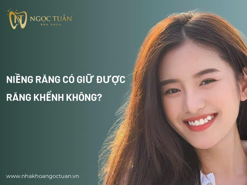 có giữ được răng khểnh khi niềng răng không?