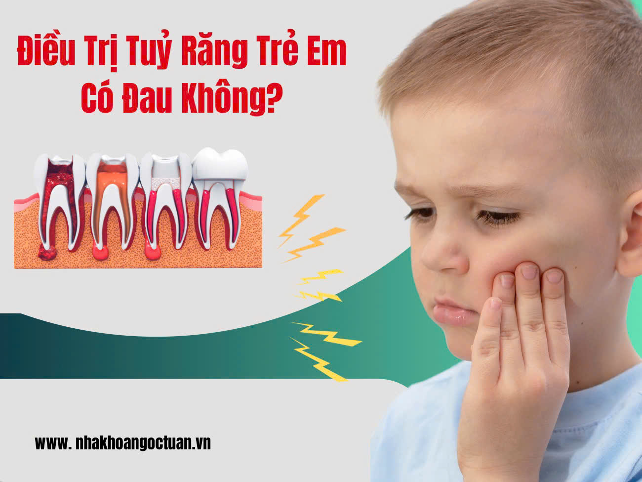 Điều trị tủy ở trẻ em có đau không