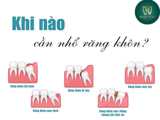 khi nào nên nhổ răng khôn