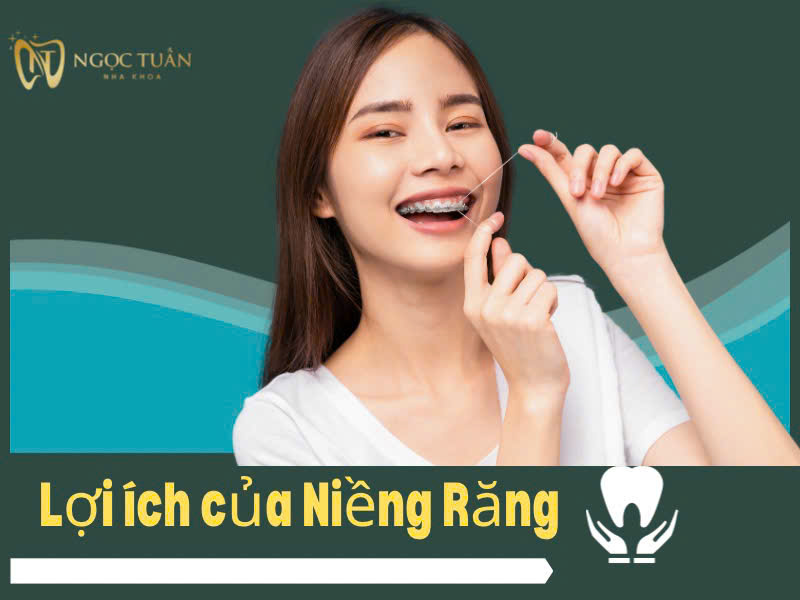 Lợi ích của niềng răng