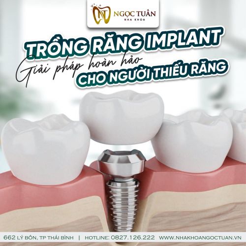 Cấy Ghép Implant Tại Thái Bình – Quy Trình, Chi Phí, Và Địa Chỉ Uy Tín