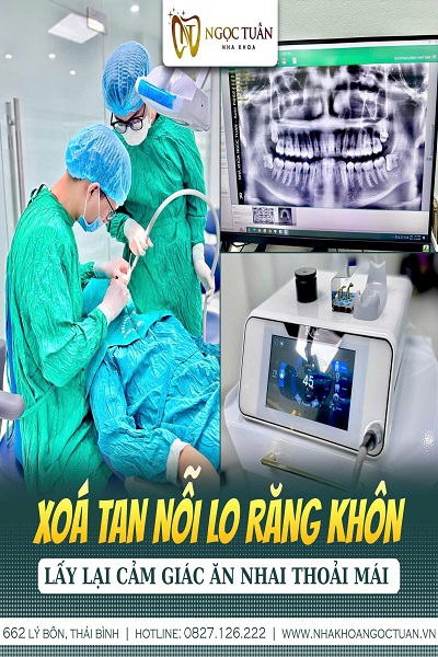 Nhổ răng khôn