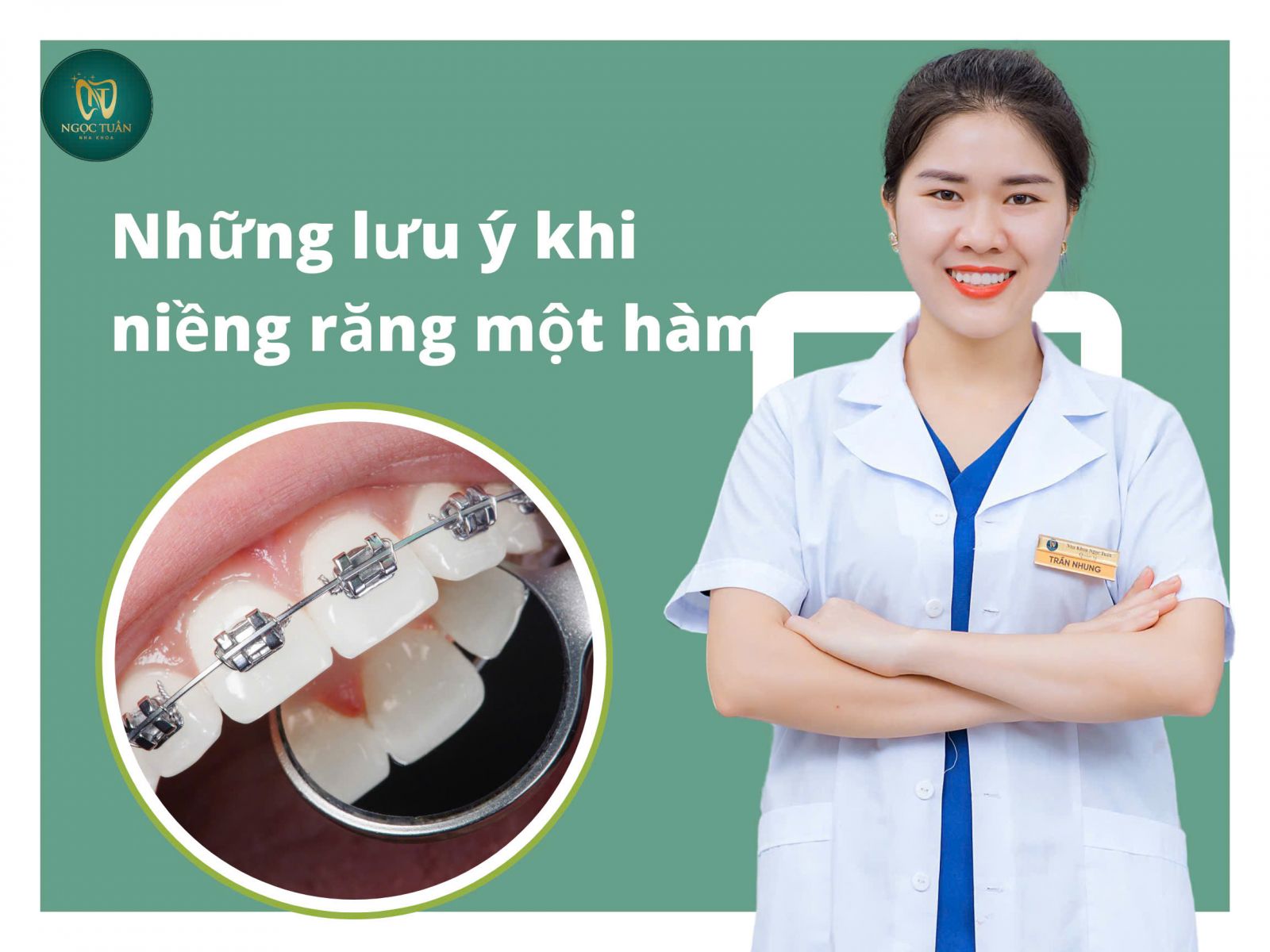 những lưu ý khi niềng răng một hàm