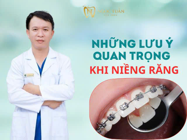 những lưu ý khi niềng răng