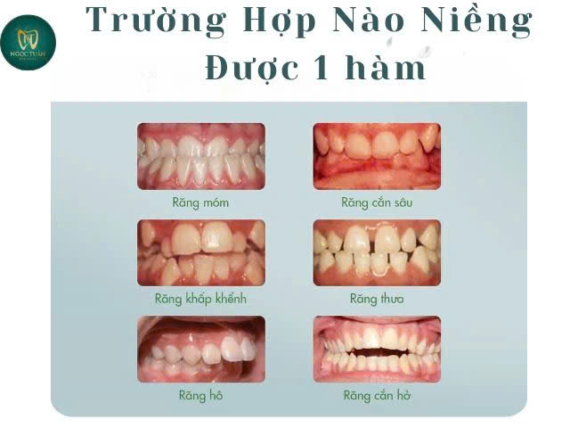 những trường hợp niềng răng 1 hàm