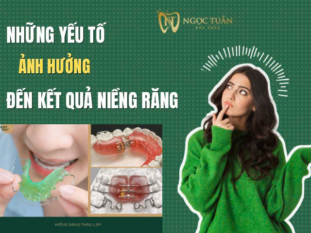 những yếu tố ảnh hưởng đến kết quả niềng răng