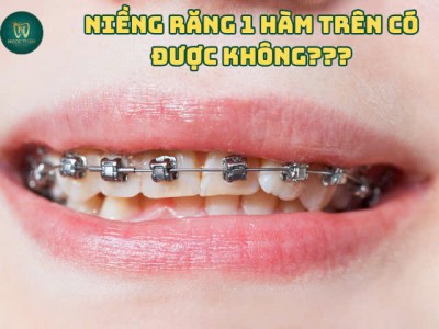 Niềng Răng 1 Hàm Có Được Không? Nha Khoa Ngọc Tuấn