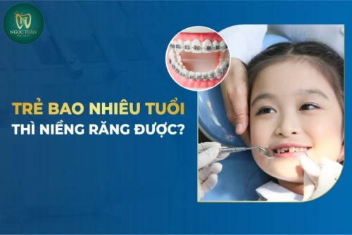 Trẻ Em Có Nên Niềng Răng Sớm Không? Độ Tuổi Phù Hợp Nhất Để Niềng Răng