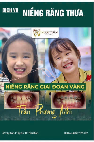 Niềng răng mắc cài