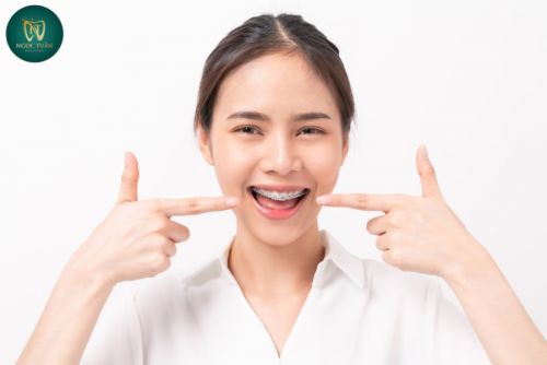 Niềng Răng Mắc Cài Kim Loại Tại Đông Hưng – Chi Phí Bao Nhiêu?