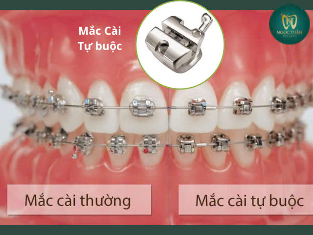 nieng răng mắc cài kim loại tự buộc rút ngắn thời gian niềng răng