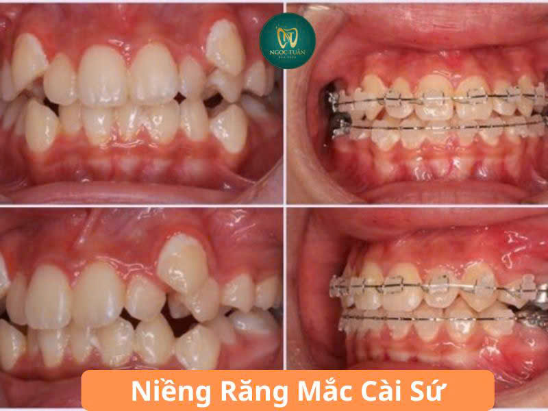 niềng răng mắc cài sứ