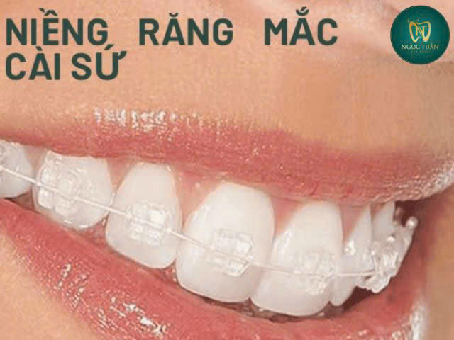 nieng răng mắc cài sứ