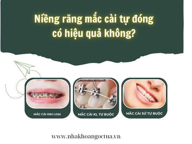 Niềng răng mắc cadi tự đóng có hiệu quả không