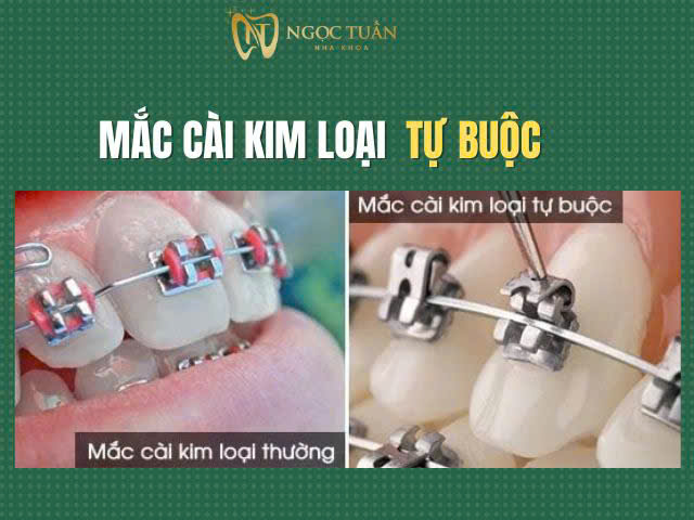 So sánh niềng răng mắc cài thường và mắc cài tự đống