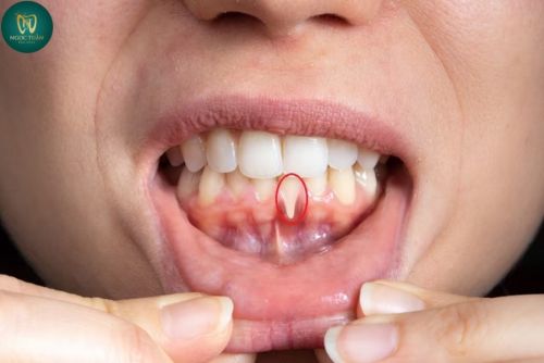 Tụt Lợi Là Gì? Nguyên Nhân Gây Tụt Lợi Và Cách Điều Trị Hiệu Quả