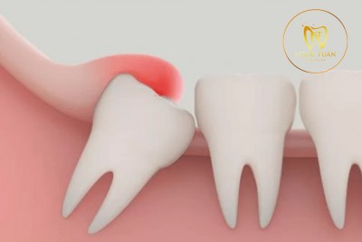 Viêm Lợi Trùm Răng Khôn Có Tự Khỏi Không? Cách điều trị dứt điểm bệnh