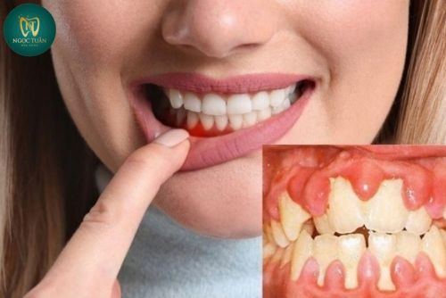 Viêm Nướu Răng - Nguyên Nhân, Dấu Hiệu Và Cách Chữa Trị Dứt Điểm