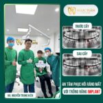 Hình ảnh feedback thực tế khách hàng sau khi cấy ghép Implant tại Nha Khoa Ngọc Tuấn Thái Bình. Khôi phục khả năng ăn nhai, nụ cười rạng rỡ và thẩm mỹ tự nhiên.
