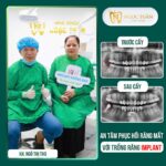 Hình ảnh feedback thực tế khách hàng sau khi cấy ghép Implant tại Nha Khoa Ngọc Tuấn Thái Bình. Khôi phục khả năng ăn nhai, nụ cười rạng rỡ và thẩm mỹ tự nhiên.
