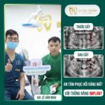 Hình ảnh feedback thực tế khách hàng sau khi cấy ghép Implant tại Nha Khoa Ngọc Tuấn Thái Bình. Khôi phục khả năng ăn nhai, nụ cười rạng rỡ và thẩm mỹ tự nhiên.