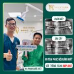 Hình ảnh feedback thực tế khách hàng sau khi cấy ghép Implant tại Nha Khoa Ngọc Tuấn Thái Bình. Khôi phục khả năng ăn nhai, nụ cười rạng rỡ và thẩm mỹ tự nhiên.