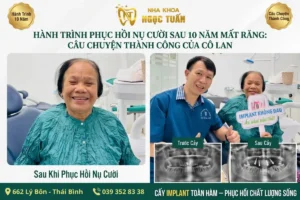 Cô Lan cười rạng rỡ sau khi thực hiện cấy ghép Implant toàn hàm tại Nha Khoa Ngọc Tuấn, 662 Lý Bôn, Thái Bình.