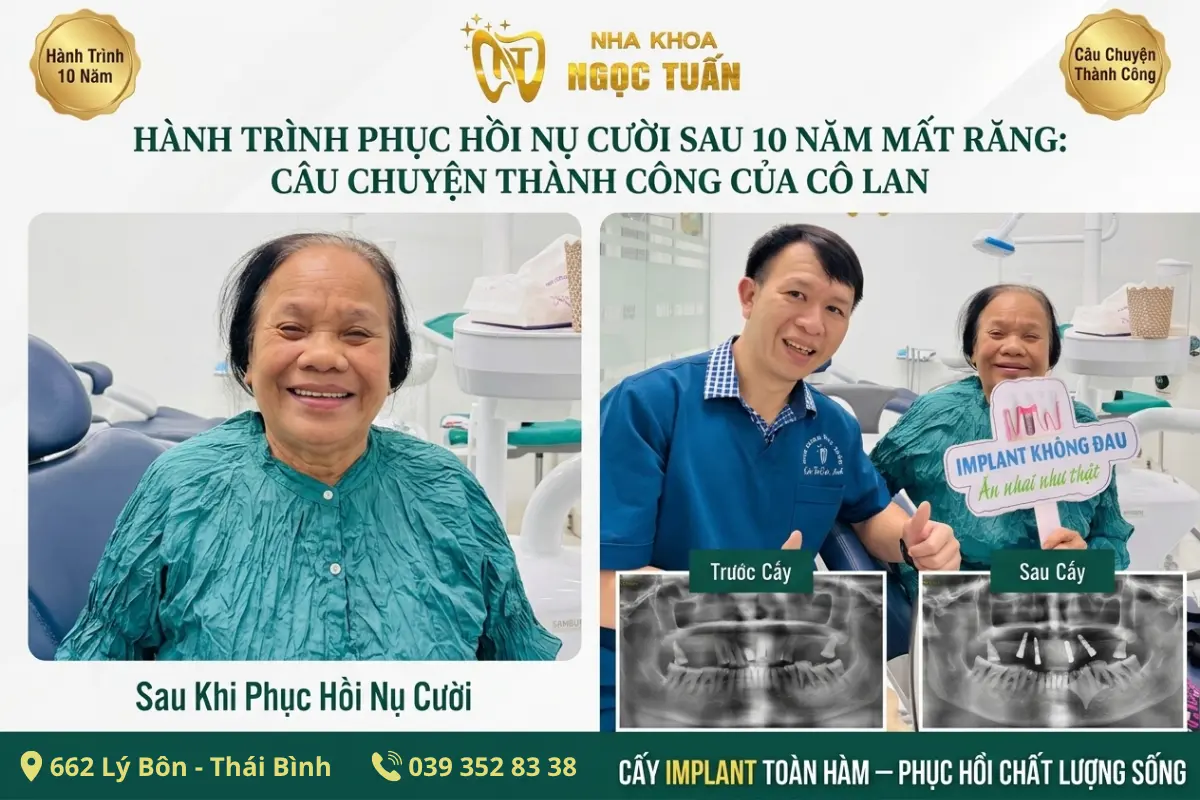 Cô Lan cười rạng rỡ sau khi thực hiện cấy ghép Implant toàn hàm tại Nha Khoa Ngọc Tuấn, 662 Lý Bôn, Thái Bình.