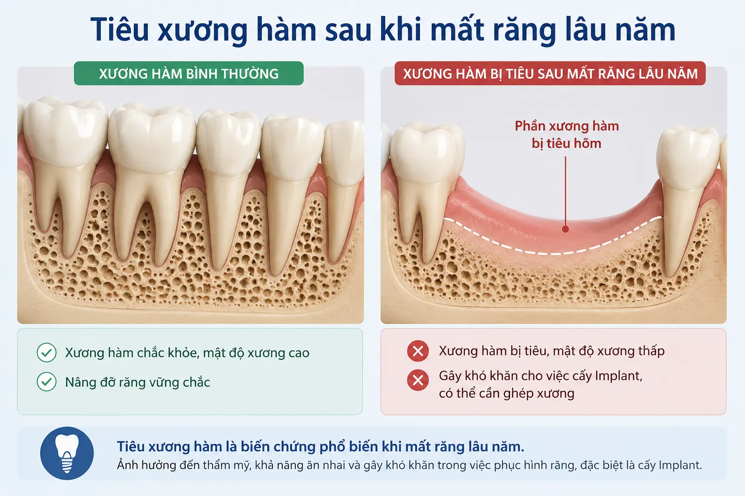 Hình ảnh tiêu xương hàm sau khi mất răng lâu năm. Tình trạng tiêu xương ảnh hưởng đến khả năng cấy ghép Implant và có thể cần ghép xương trước điều trị.