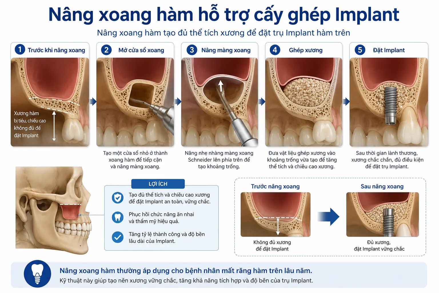 Hình ảnh nâng xoang hàm trong điều trị Implant. Phương pháp này giúp bổ sung chiều cao xương hàm trên cho bệnh nhân mất răng lâu năm.