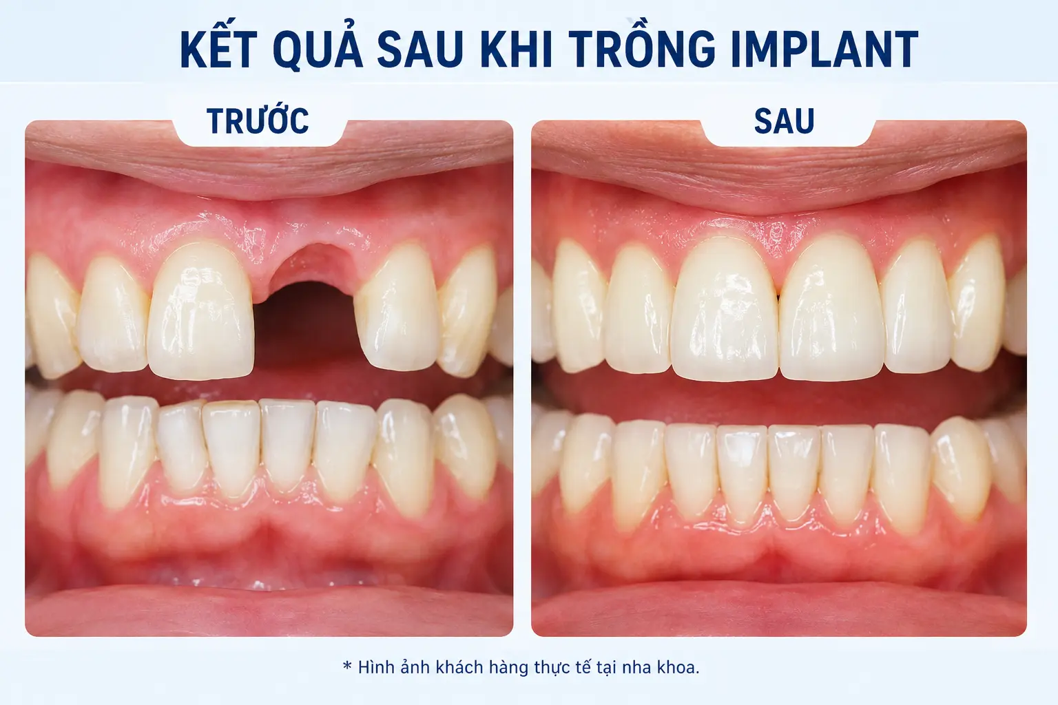 Kết quả phục hình răng Implant cho bệnh nhân mất răng lâu năm, khôi phục thẩm mỹ nụ cười và khả năng ăn nhai gần như răng thật.