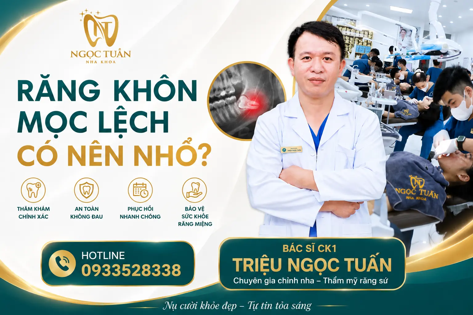 Banner răng khôn mọc lệch có nên nhổ? Bác sĩ Nha khoa Ngọc Tuấn tư vấn thời điểm nhổ an toàn, hạn chế biến chứng.