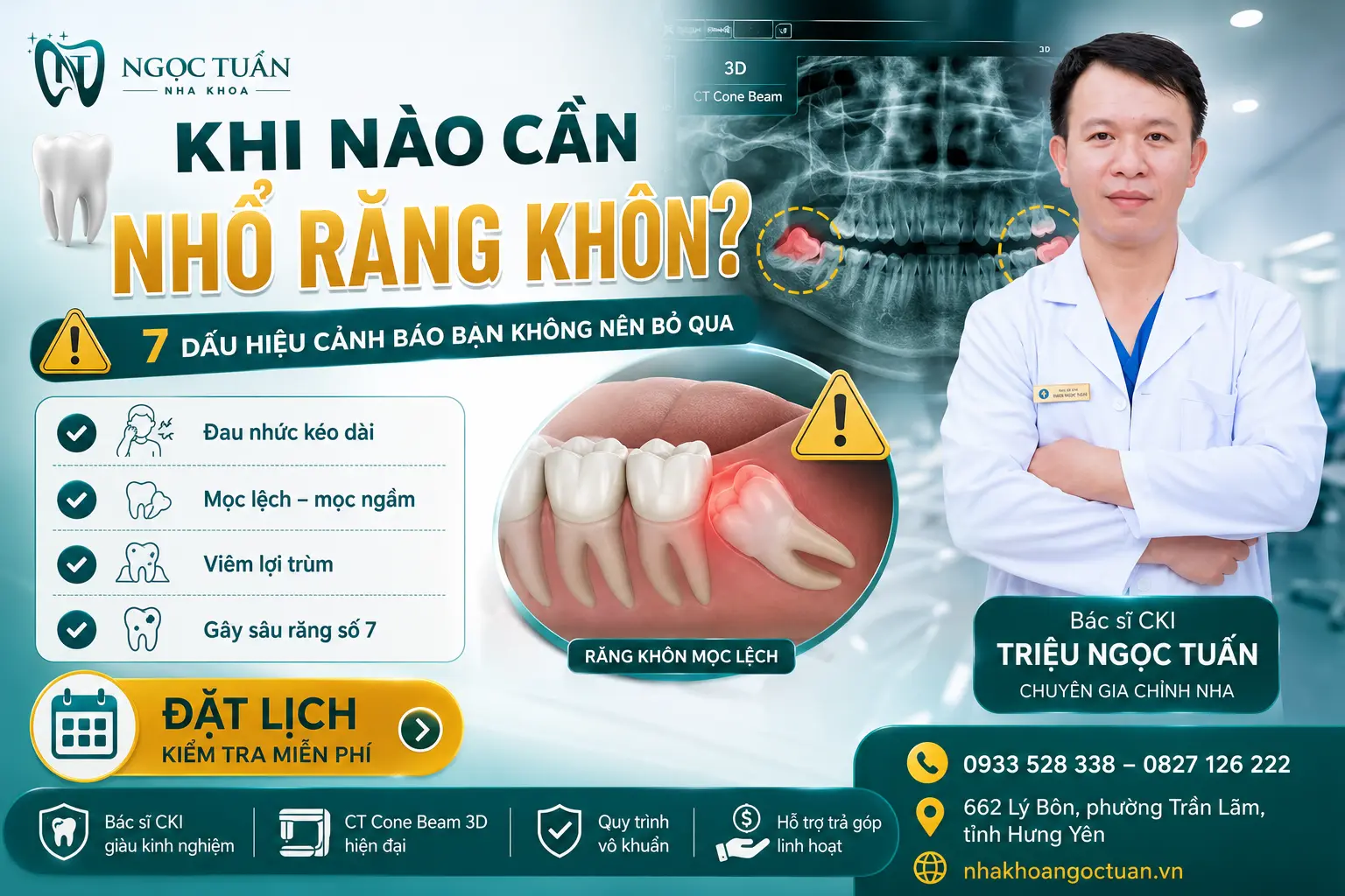 Khi nào cần nhổ răng khôn? 7 dấu hiệu cảnh báo cần nhổ răng khôn sớm để tránh biến chứng tại Nha khoa Ngọc Tuấn.