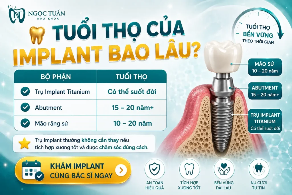Bảng so sánh tuổi thọ của trụ Implant, Abutment và mão răng sứ, giúp khách hàng hiểu rõ cấu tạo và độ bền của từng bộ phận.