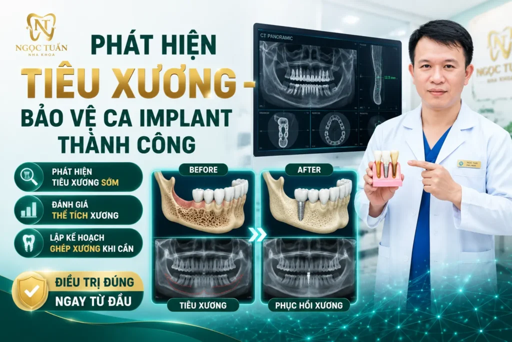 Công nghệ CT Cone Beam hỗ trợ đánh giá mức độ tiêu xương và chỉ định ghép xương khi cần thiết trước khi cấy ghép Implant.