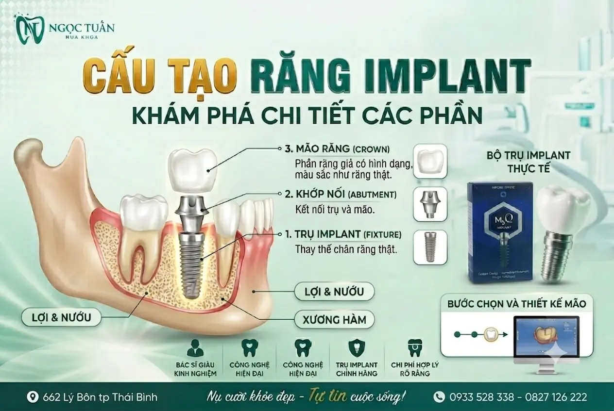 Cấu tạo răng Implant gồm trụ Implant, khớp nối Abutment và mão răng sứ. Tìm hiểu chi tiết từng bộ phận giúp phục hồi răng mất bền chắc, thẩm mỹ và ăn nhai như răng thật.