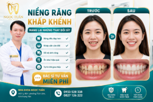 Lợi ích của niềng răng khấp khểnh tại Nha khoa Ngọc Tuấn