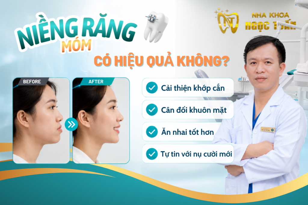 Niềng răng móm có hiệu quả không tại Nha khoa Ngọc Tuấn