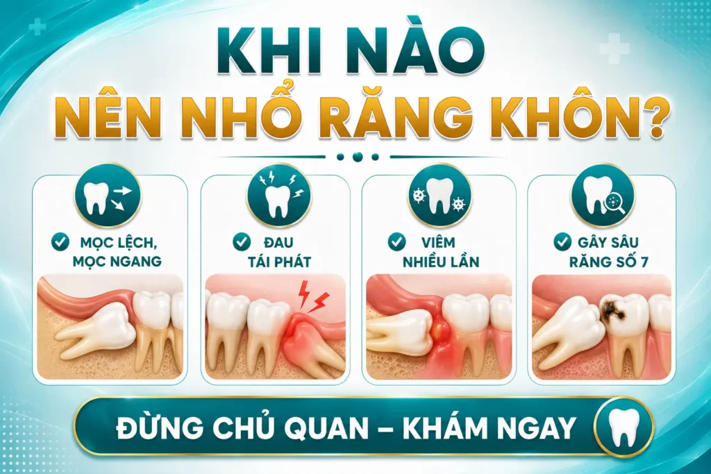 Các trường hợp nên nhổ răng khôn mọc lệch.