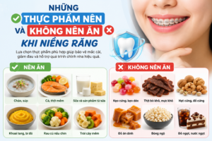 Những thực phẩm nên và không nên ăn khi niềng răng